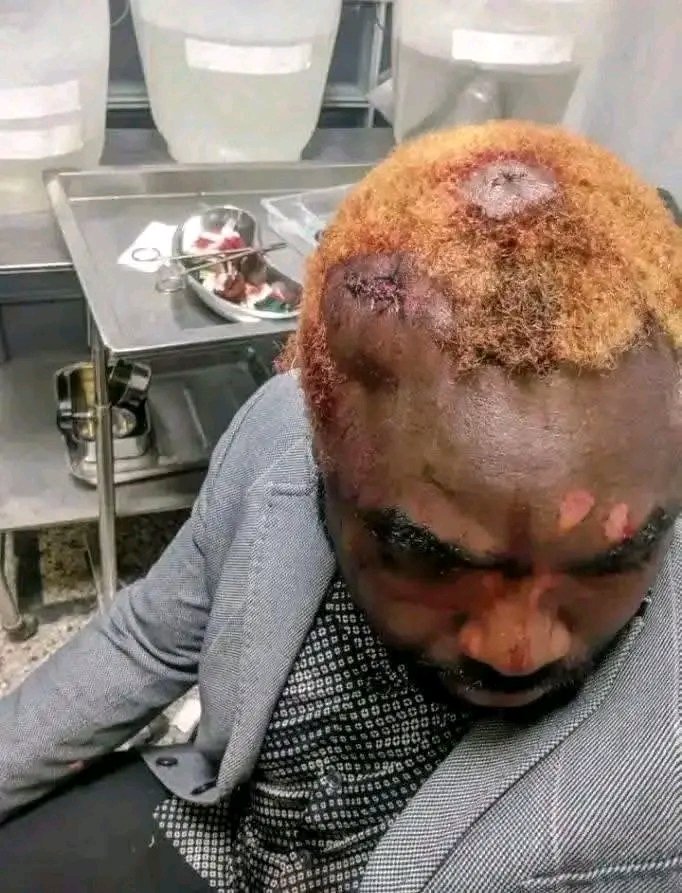 “I almost died,” General Kanene recounts brutal attack by UPND cadres in Mwembeshi